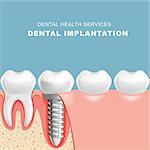 Gum section with dental implantat - row of teeth