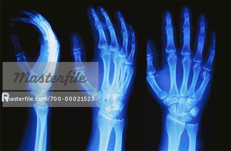 Radiographie de la main droite