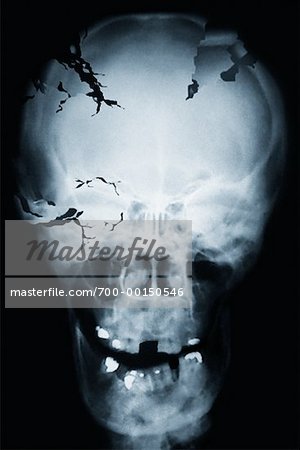 Radiographie du crâne fissuré