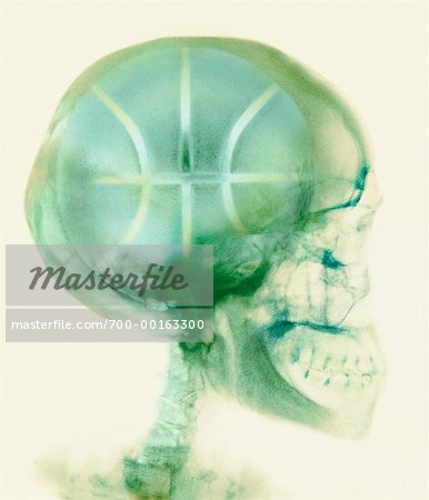 X-Ray of Skull with Basketball