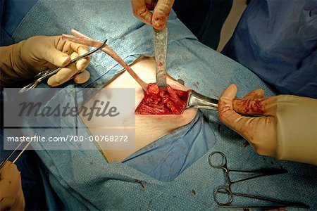 Hernia Operation