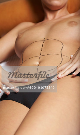 Woman with Markings for Liposuction
