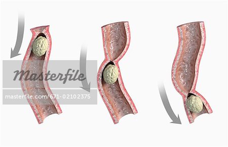 Peristalsis