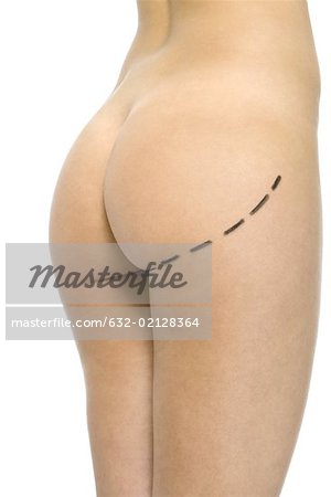 Femme nue avec des marques de chirurgie plastique sur les fesses, recadrée vue