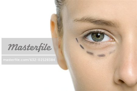 Junge Frau mit plastischen Chirurgie Markierungen unter Auge, beschnitten anzeigen