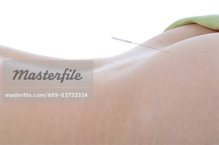 Femme ayant les aiguilles d'acupuncture dans le dos