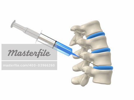 3d rendered anatomy illustration from a part of a spine with an injection