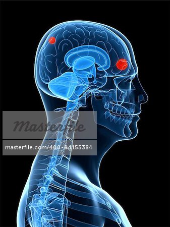 3d rendered x-ray illustration of a human head with tumor in brain