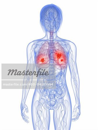 3d rendered illustration of a transparent female anatomy with tumor in lung