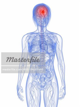 3d rendered illustration of a transparent female body with tumor in brain