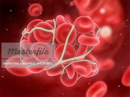 3d rendered illustration of a blood clot in an artery