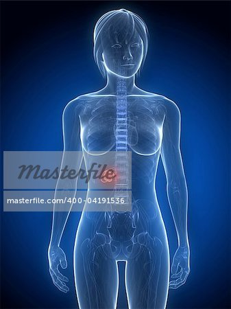 3d rendered illustration of a transparent female body with tumor in gallbladder