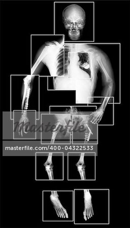 X-ray picture of human