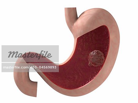 3d rendered anatomy illustration of a human stomach with carzinom