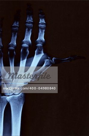 Left hand radiography with wrist and upper arm