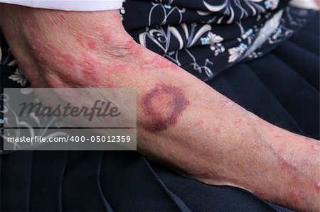 Bruise and sceriosis on the arm of an elderly female. The elderly have a tendency to bruise more easily than younger people.