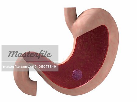 3d rendered anatomy illustration of a human stomach with ulcer