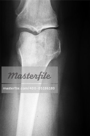 Medical x-ray of a damaged knee in vertical format