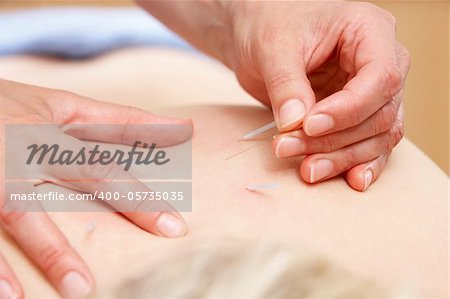 Acupuncturist treating female client