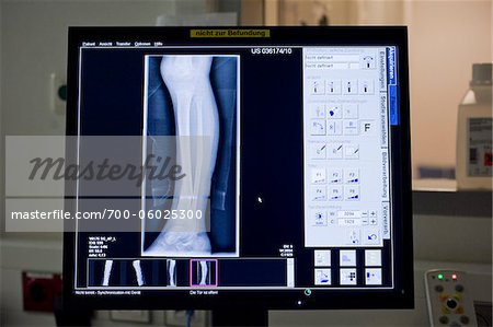 X-ray von gebrochenen Bein auf dem Bildschirm im Krankenhaus