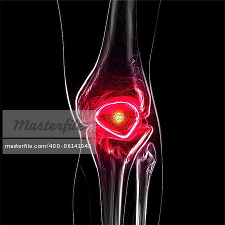 x ray of knee showing knee pain