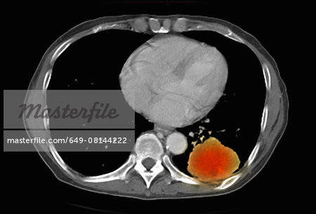 Image from a co-registered PET-CT study from dual modality scanner. Patient with multiple metastatic lesions in liver & lung. PET data superimposed over CT scan axial slice through lung metastases