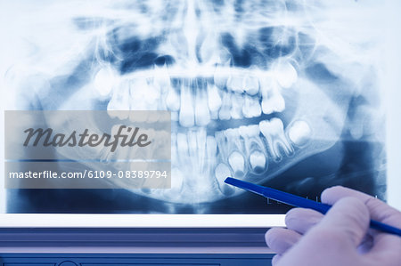 Gloved hand holding pen to teeth x-ray