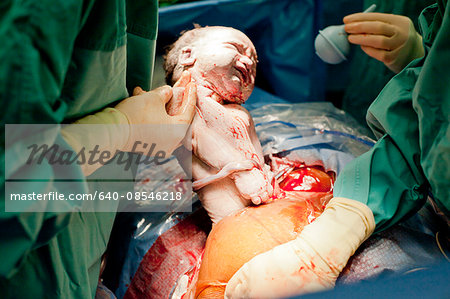 Baby being born via cesarian section operation