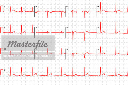 Typical human electrocardiogram, red graph with marks on white