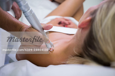 Dermatologist removing mole from womans shoulder with medical laser