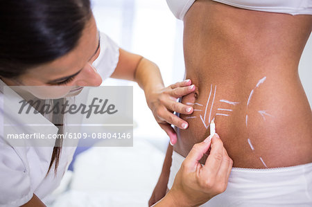 Close-up of surgeon drawing lines on womans abdomen for liposuction and cellulite removal