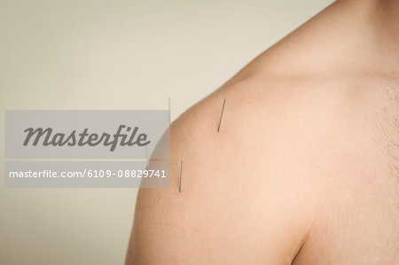 Close-up of a patient getting dry needling