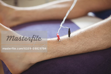 Patient getting electro dry needling on leg