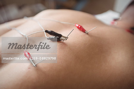 Patient getting electro dry needling on his back