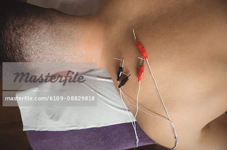 Close-up of patient getting electro dry needling on his shoulder