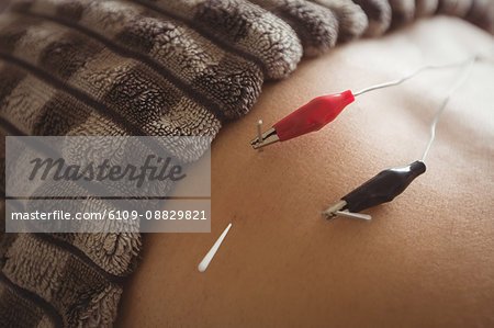 Close-up of patient getting electro dry needling