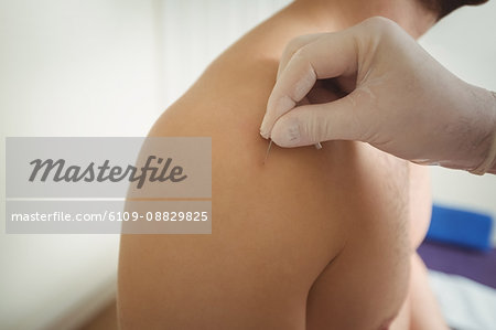 Close-up of physiotherapist performing dry needling on patient