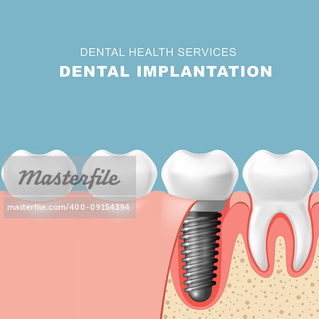 Teeth and dental implantat inserted into gum - tooth implantation