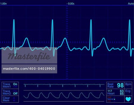 heart monitor screen with normal beat signal