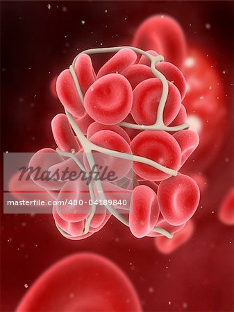 3d rendered illustration of a blood clot in an artery