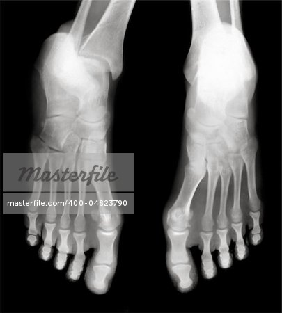 Foot fingers exposed on x-ray black and white film