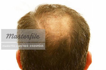male head with hair loss symptoms