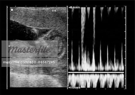 ultrasound fetus at 12 weeks