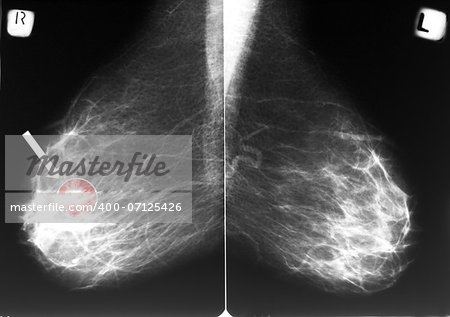 Mammogram film with arrow indicating an abnormal area