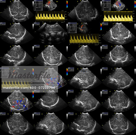 composition of detail ultrasound pictures from ultrasound examination