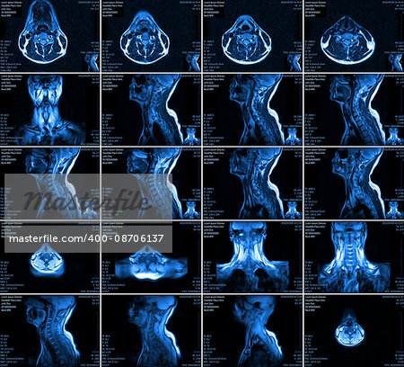 Magnetic resonance imaging of the cervical spine. MRI vertebral discs in different views