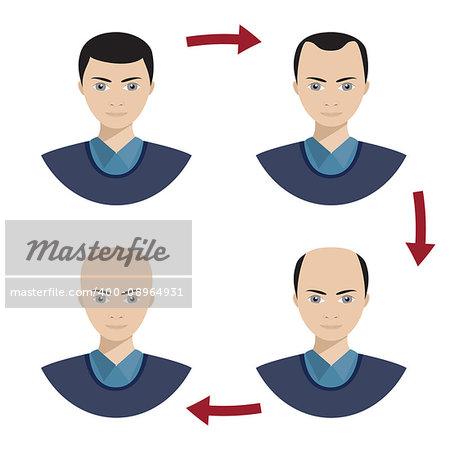 Information chart showing four stages of hair loss for men. Bolding head from full hair cover to a final stage of baldness. Also available as a Vector in Adobe illustrator EPS 10 format.