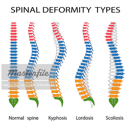 Illustration of spinal deformity types. Kyphosis, lordosis and scoliosis. Also available as a Vector in Adobe illustrator EPS 10 format.
