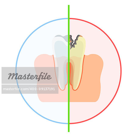 Tooth is healthy and damaged by caries, with hole. Flat vector cartoon illustration. Objects isolated on white background.