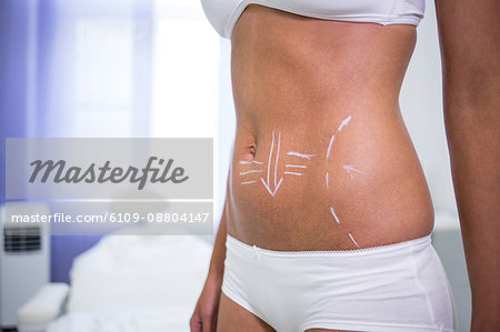 Mid section of female body with the drawing arrows for abdomen for liposuction and cellulite removal